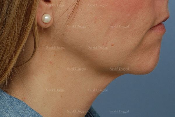 Mini Facelift before, case 2579