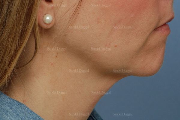 Mini Facelift before, case 2579