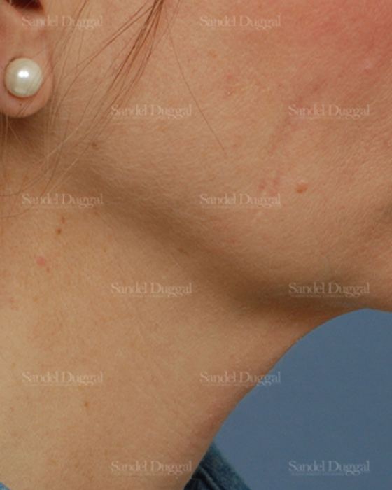 Mini Facelift before, case 2579