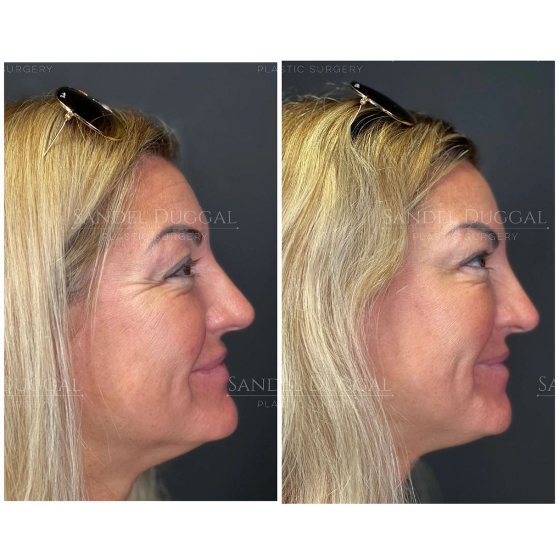 Botox & Fillers before and after, case 6010