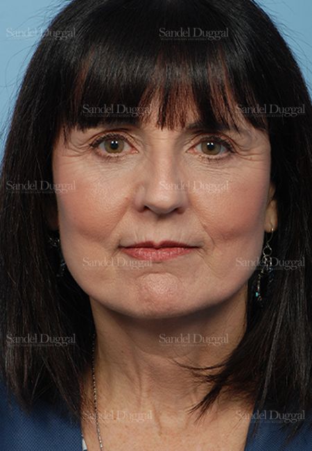 Facelift after, case 2661