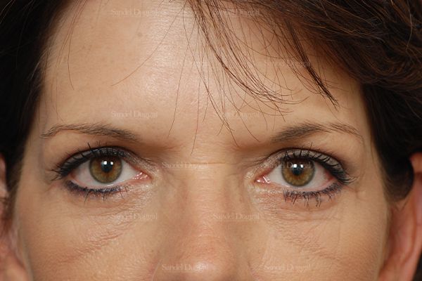 Eyelid Rejuvenation after, case 1960