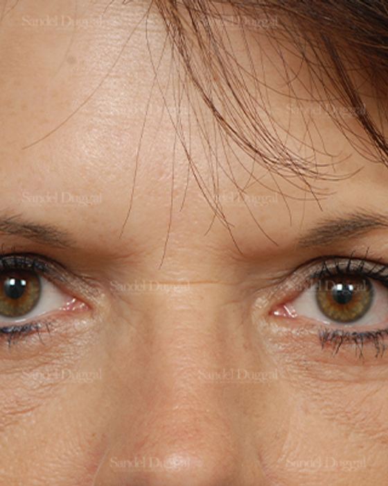 Eyelid Rejuvenation after, case 1960