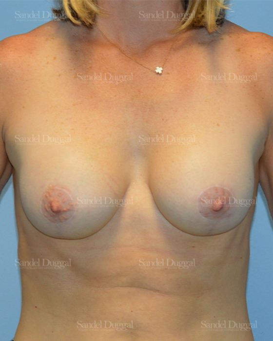 Breast Augmentation with Lift after, case 3393