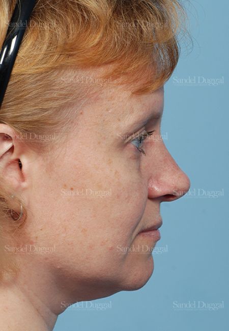 Rhinoplasty after, case 2862