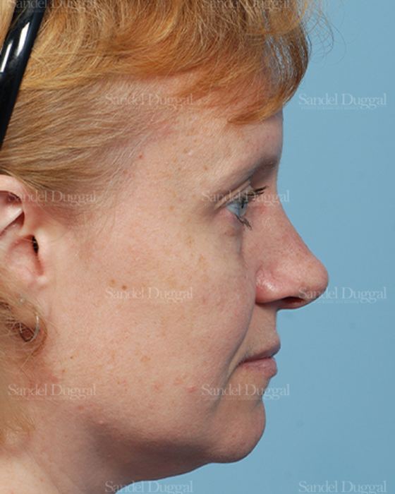 Rhinoplasty after, case 2862