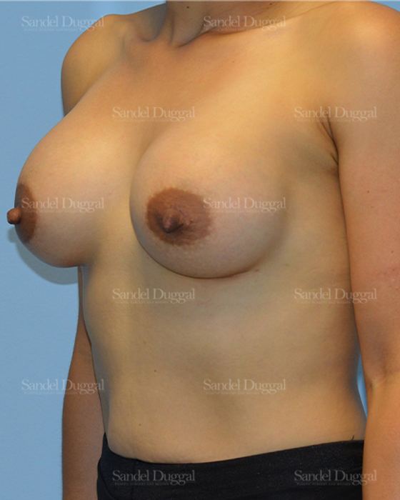 Breast Augmentation after, case 3255
