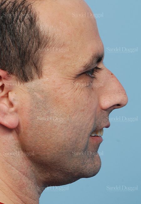 Rhinoplasty before, case 2909