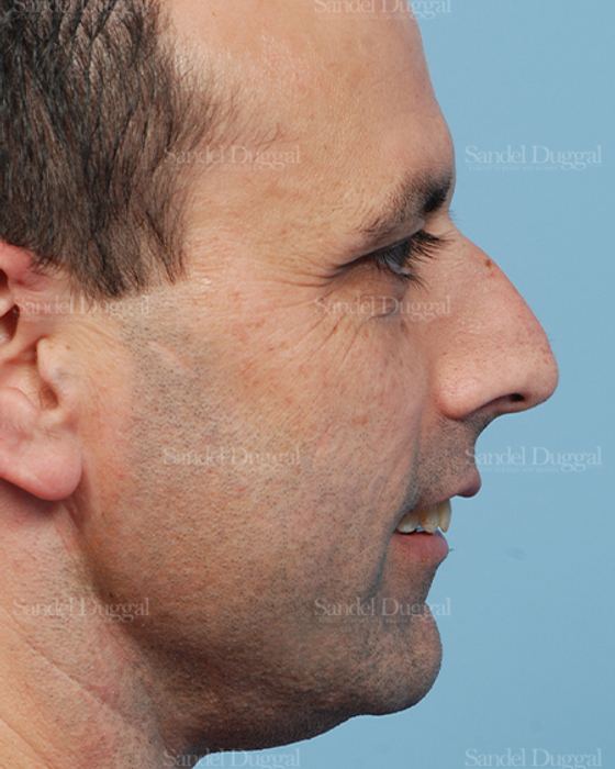 Rhinoplasty before, case 2909