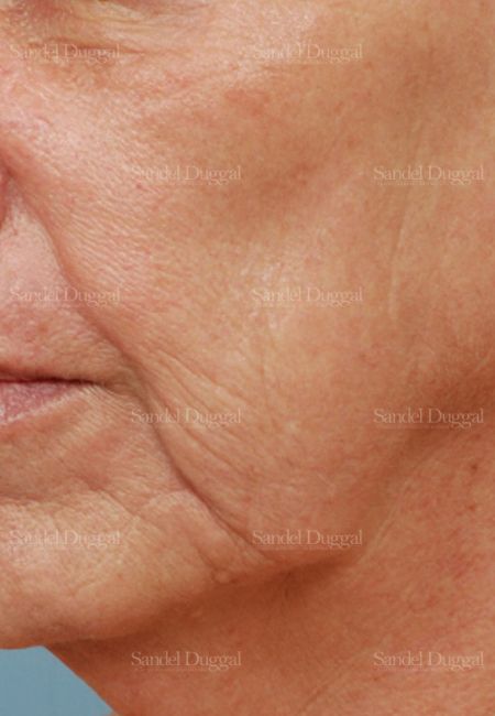 Laser Skin Resurfacing after, case 2975