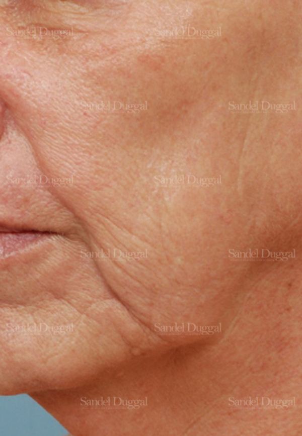Laser Skin Resurfacing after, case 2975