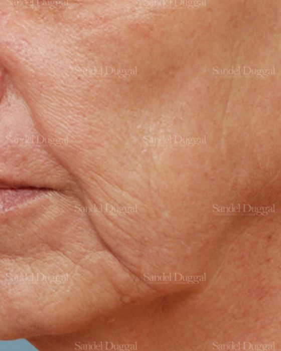 Laser Skin Resurfacing after, case 2975
