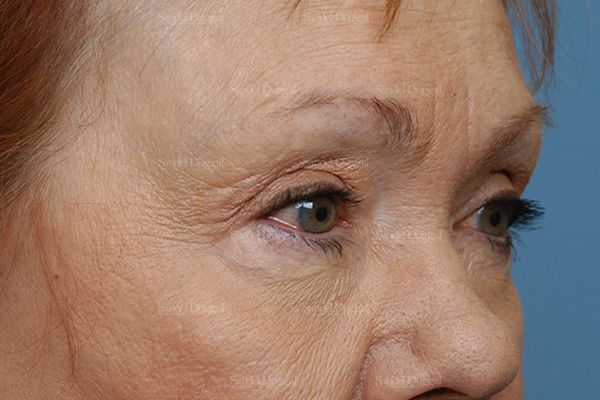 Eyelid Rejuvenation before, case 1930