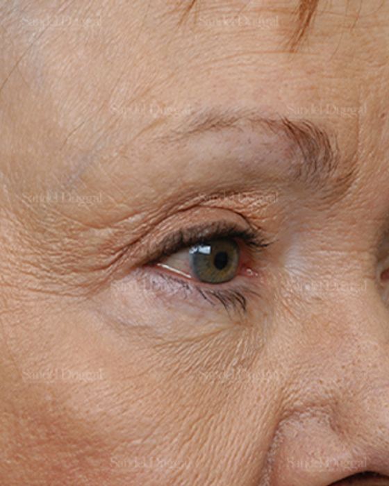 Eyelid Rejuvenation before, case 1930