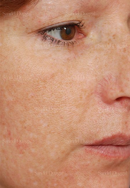 Laser Skin Resurfacing before, case 2986