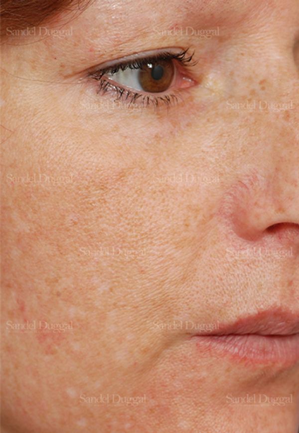 Laser Skin Resurfacing before, case 2986
