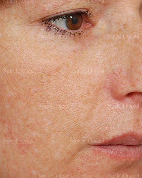 Laser Skin Resurfacing before, case 2986