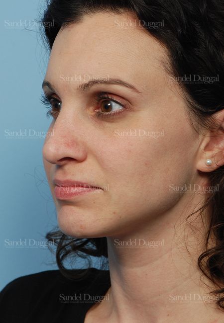 Rhinoplasty after, case 2831