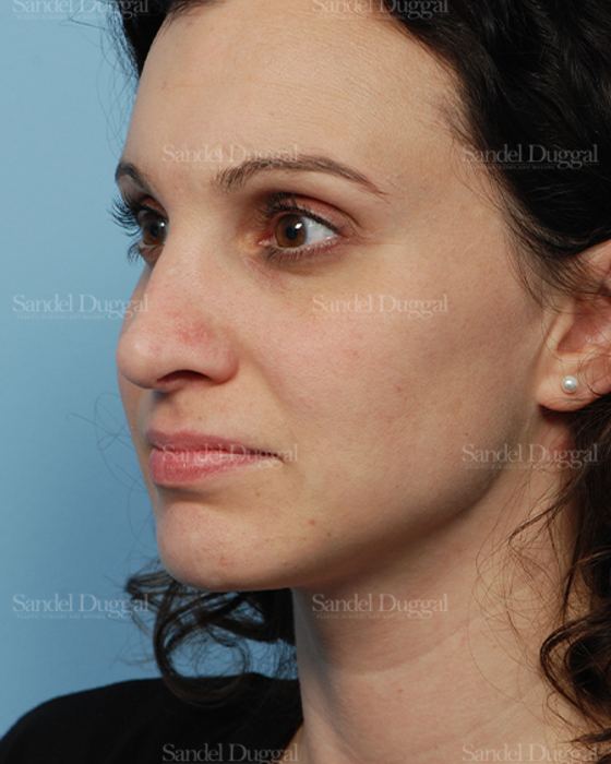 Rhinoplasty after, case 2831
