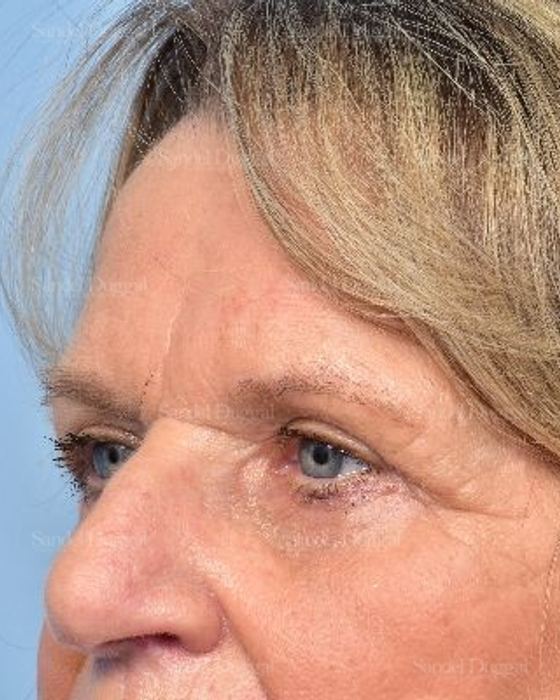 Eyelid Rejuvenation after, case 5326