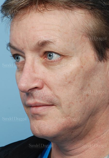 Rhinoplasty after, case 2838