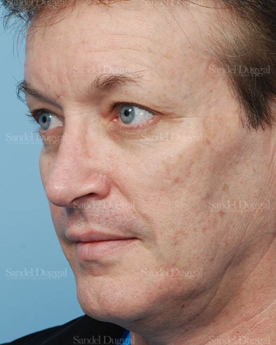 Rhinoplasty after, case 2838