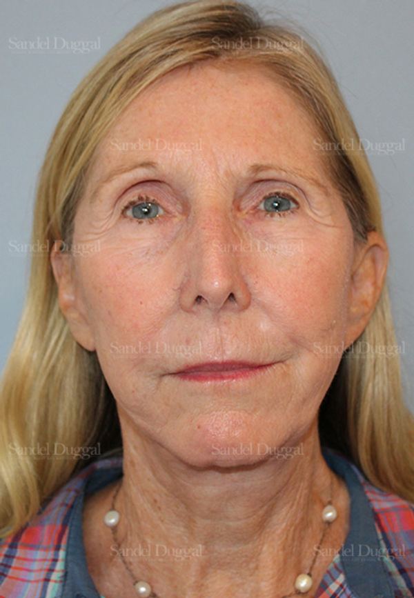 Facelift after, case 5735