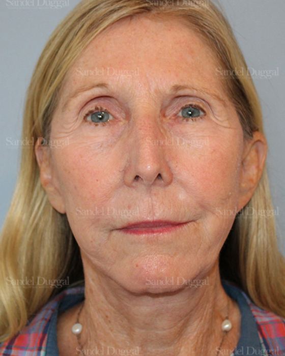 Facelift after, case 5735