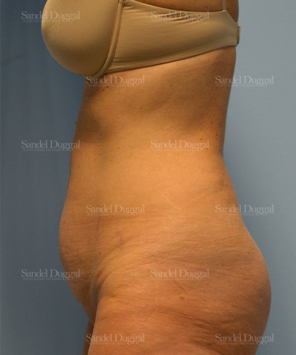 Tummy Tuck before, case 1599