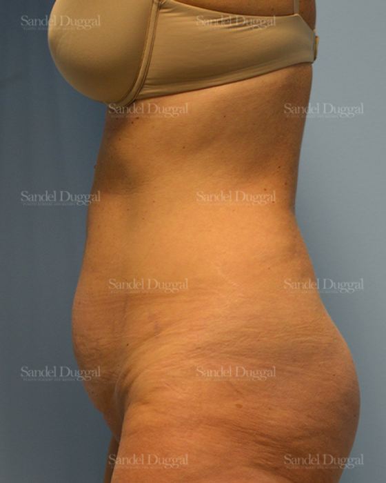Tummy Tuck before, case 1599