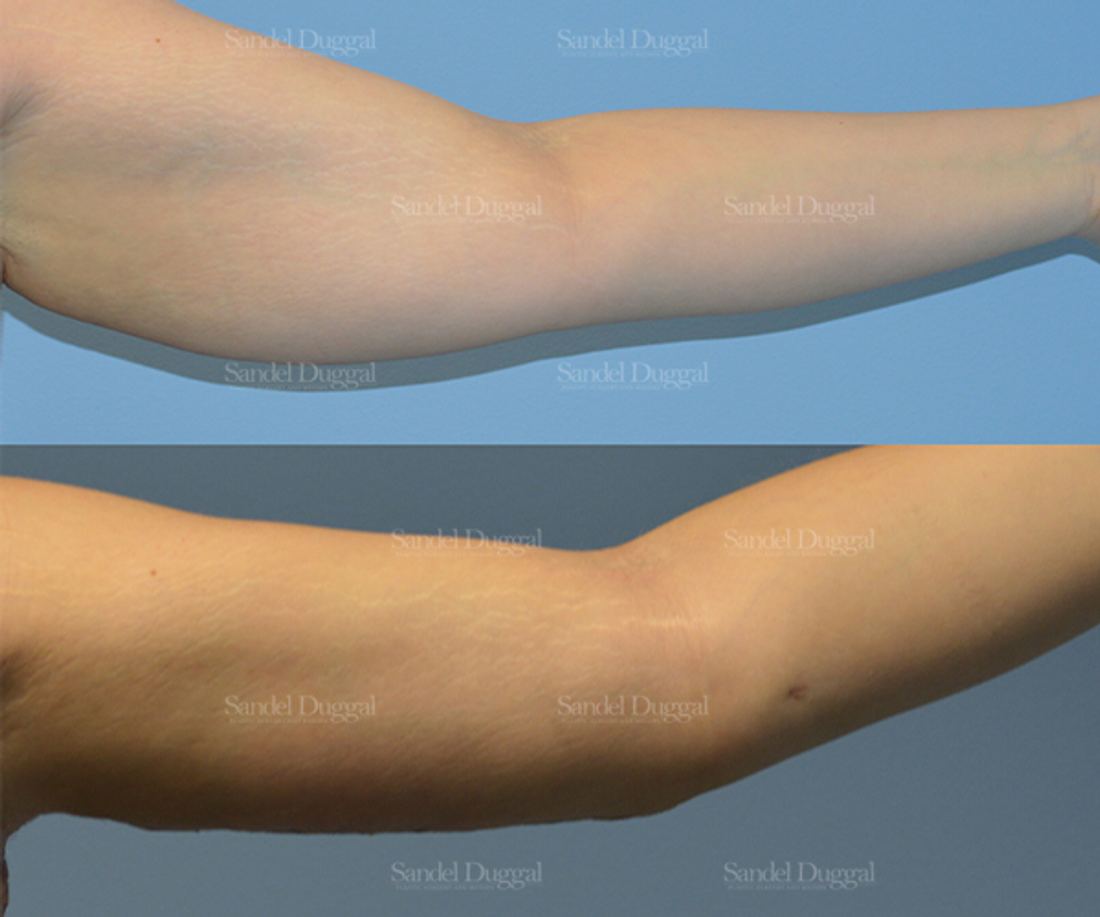 Brachioplasty before and after, case 2129
