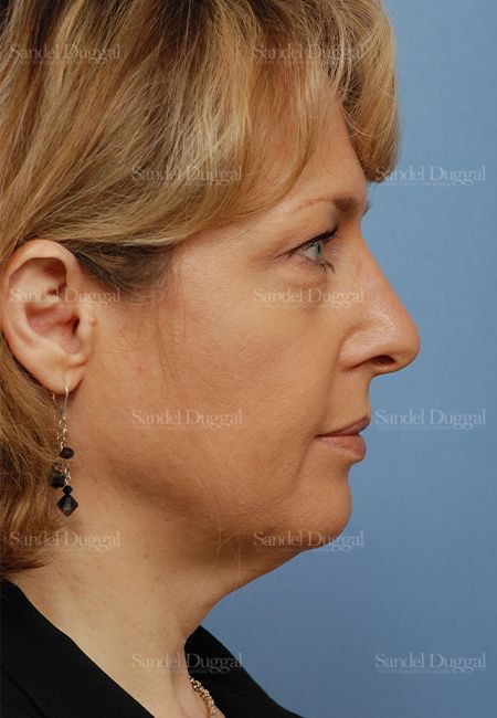 Facelift before, case 806