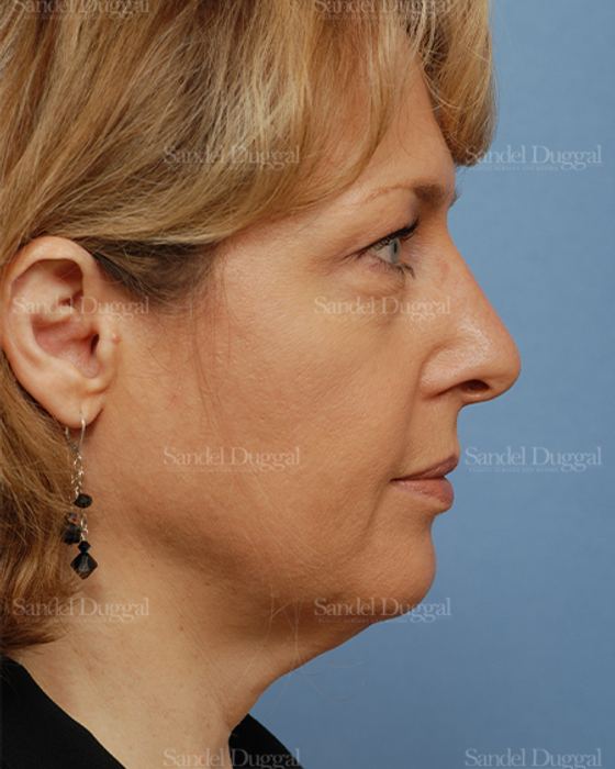 Facelift before, case 806