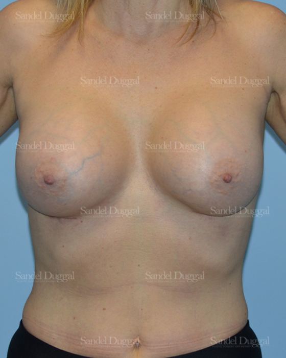 Breast Augmentation after, case 3262