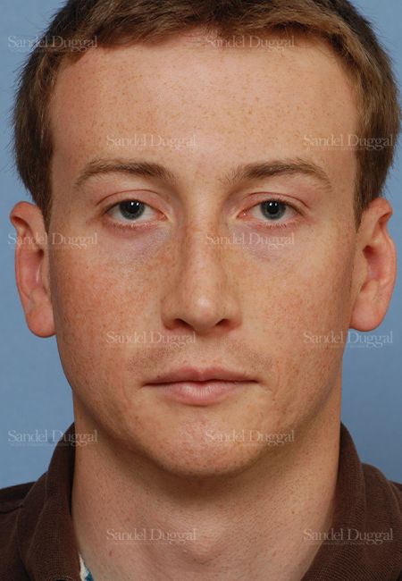 Rhinoplasty after, case 2899