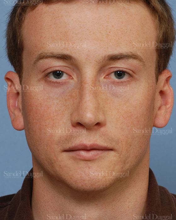 Rhinoplasty after, case 2899