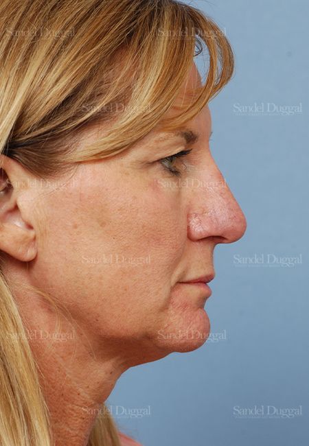 Rhinoplasty after, case 2918