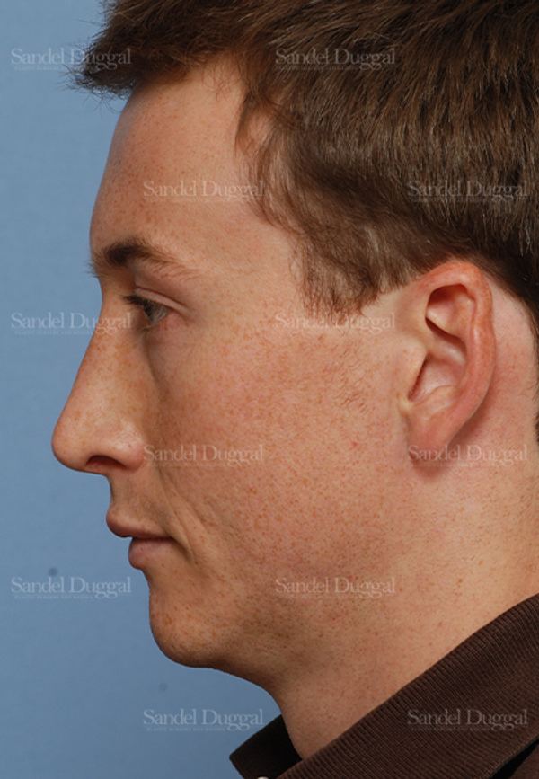 Rhinoplasty after, case 2899