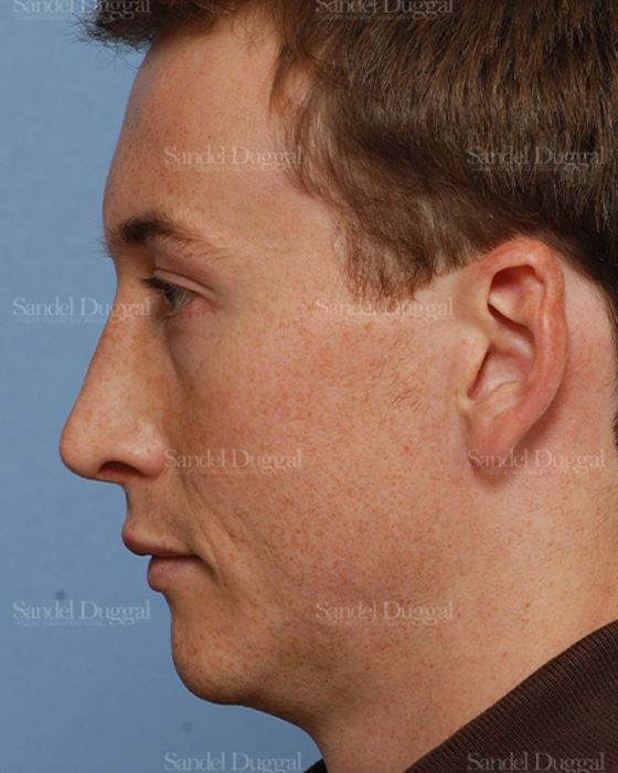 Rhinoplasty after, case 2899