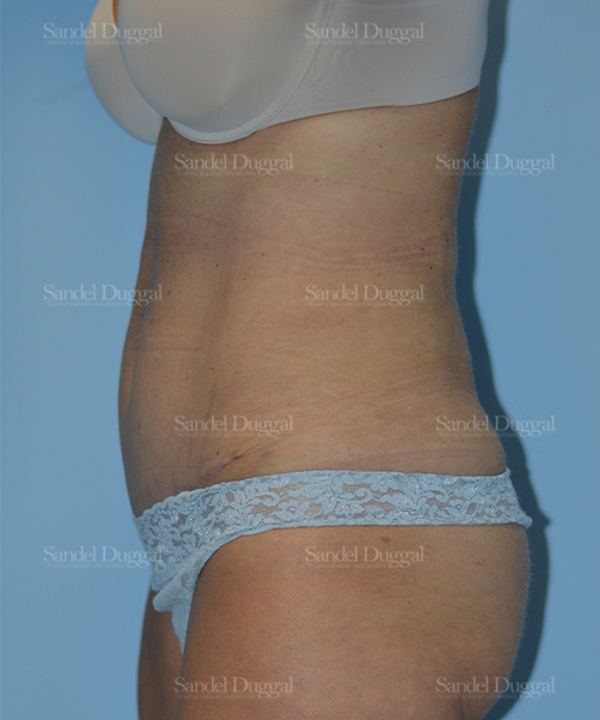 Tummy Tuck after, case 1599