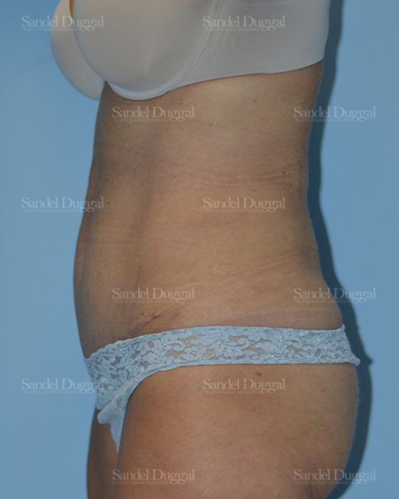 Tummy Tuck after, case 1599