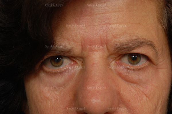 Forehead Lift before, case 2234