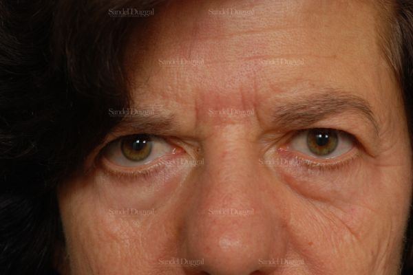 Forehead Lift before, case 2234