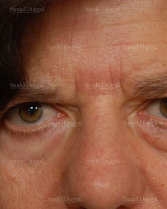 Forehead Lift before, case 2234