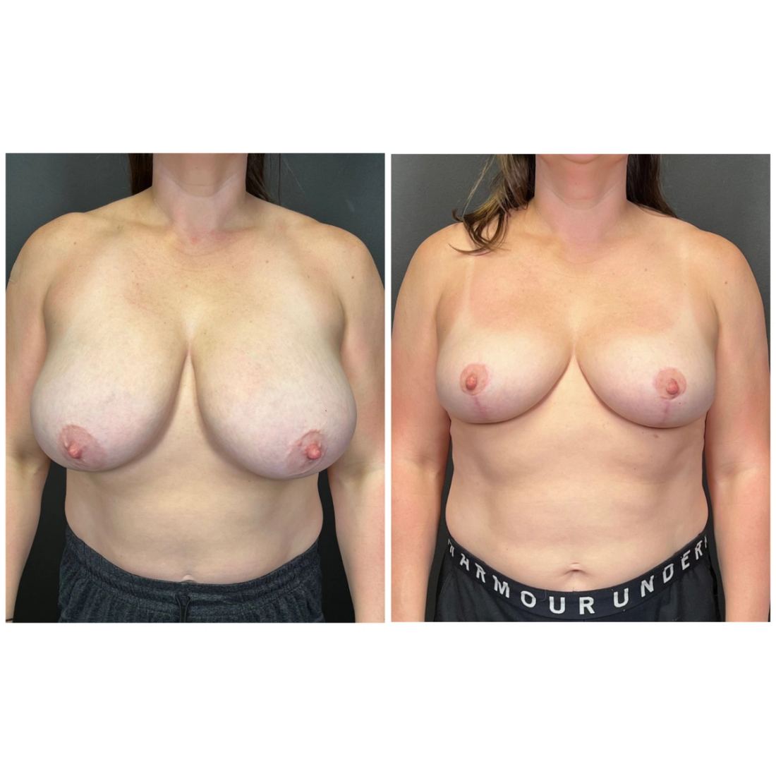 Breast Lift before and after, case breast-lift-new-01