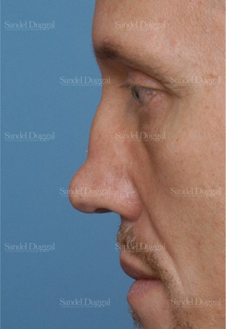Revision Rhinoplasty before, case 2609