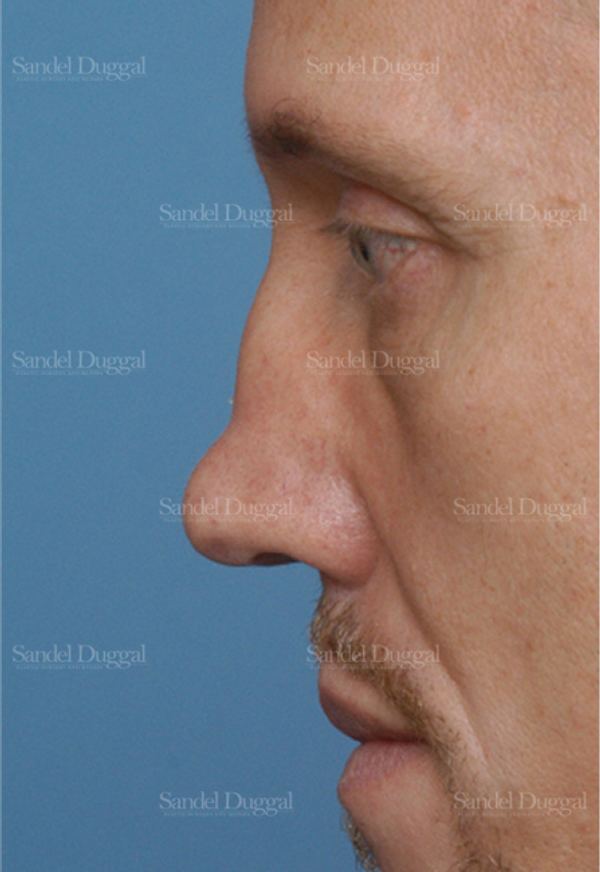 Revision Rhinoplasty before, case 2609