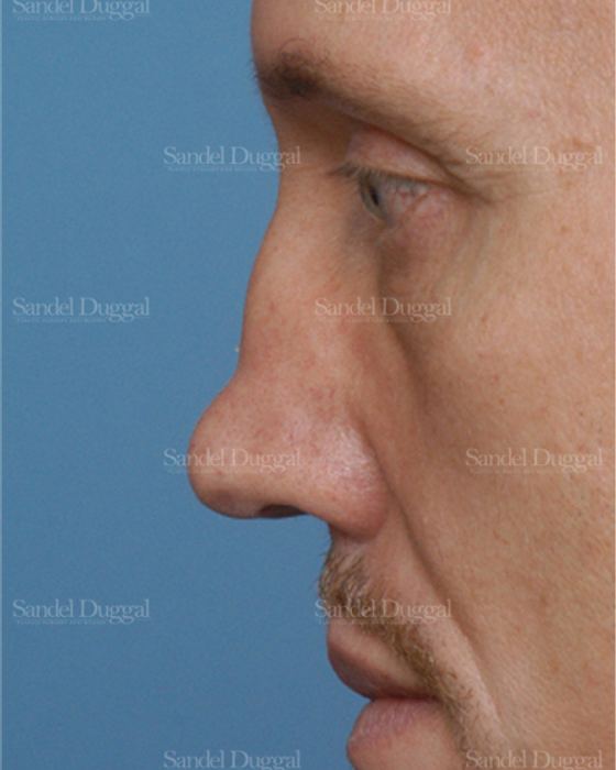 Revision Rhinoplasty before, case 2609