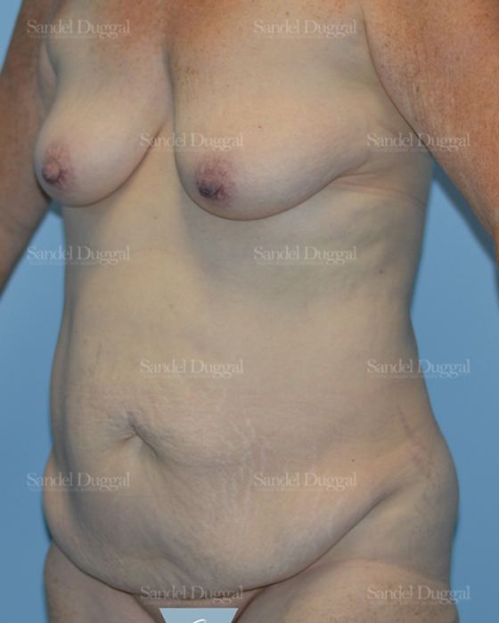 Tummy Tuck before, case 1519