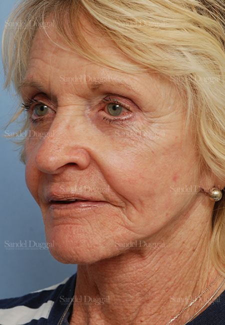 Cheek Augmentation after, case 1446